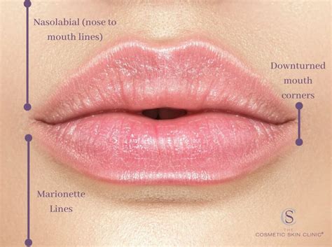 The Best Way to Fix Downturned Mouth Corners | Filler, Botox for Downturned Mouth | The Cosmetic ...