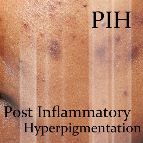 Post Inflammatory Hyperpigmentation Treatment | Dr Sin Yong