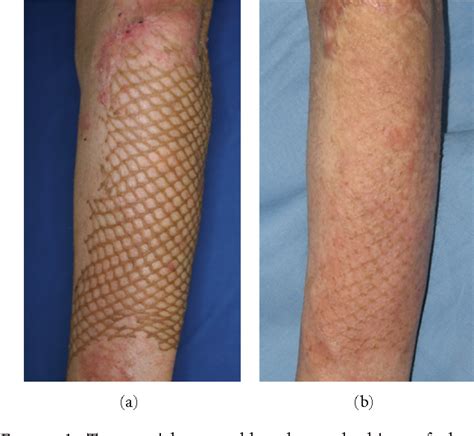 List 99+ Pictures Burn Skin Graft Before And After Pictures Stunning