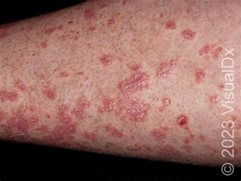 Guttate Psoriasis in Adults: Causes, Symptoms, and Treatment