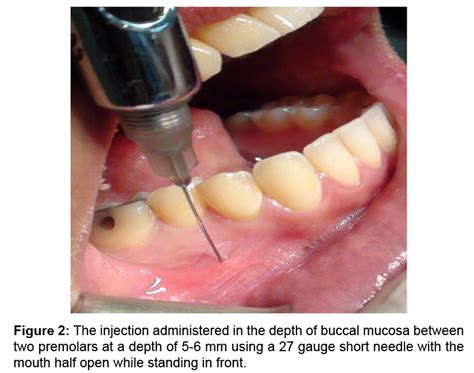 Buccal Nerve Block Technique