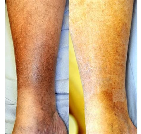 Hemosiderin Staining Legs Treatment