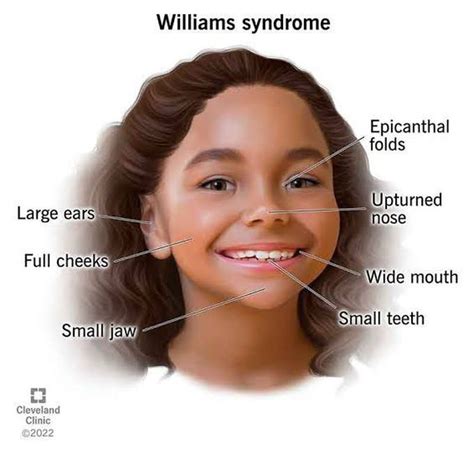 Physical Characteristics of William's syndrome - MEDizzy