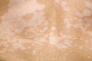 Pityriasis versicolor - NHS