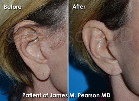 Earlobe Plastic Surgery Photos - Before & After - Dr. James Pearson Facial Plastic Surgery