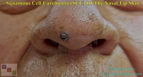 Squamous Cell Carcinoma (SCC) Of The Nasal Tip Skin