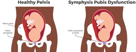 Symphysis Pubis Dysfunction (SPD) in Pregnancy