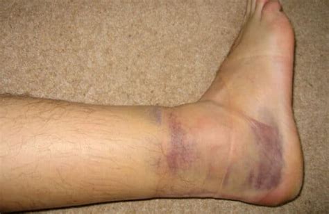 A Sprained Ankle - Causes, Symptoms, Types, Grades, Treatments