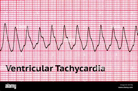 Taquicardia ventricular (VT Fotografía de stock - Alamy