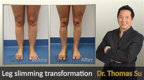 Lipedema Surgery | Liposuction | Lipo 360 Cankles & Knees, Ankles, Calves, Legs | Expert Dr. Su ...