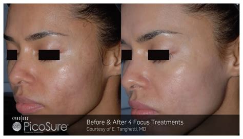 Treatment: PicoSure | Skin Med Laser