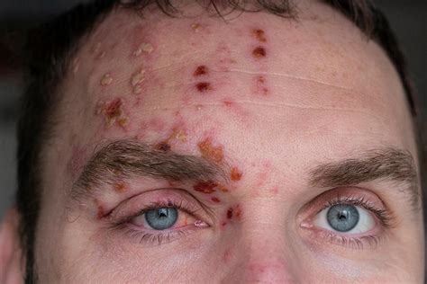 What You Need to Know About Shingles of the Eye: Scott Beeve, M.D., FACS: Ophthalmologist