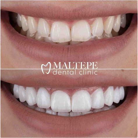 Veneers Vs. Lumineers: Which Option Is Better? - Maltepe Dental Clinic