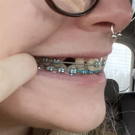 braces progress (so far) : r/braces