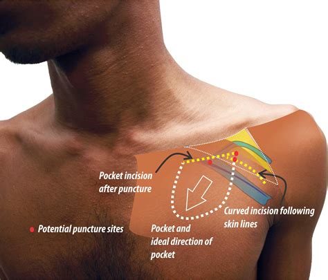 Anatomical Considerations for Creating the Pacemaker Pocket – How to Pace