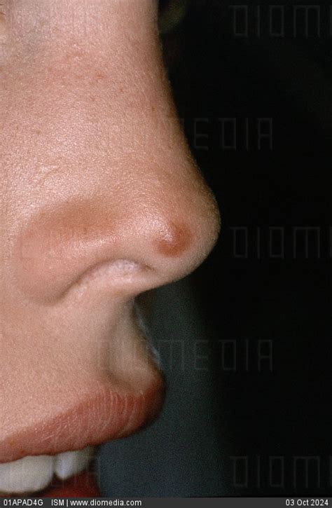 STOCK IMAGE, spitz nevus or benign juvenile melanoma on the nose of a ...