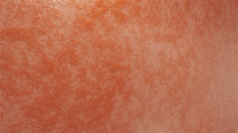 Texture Skin Infection - FlippedNormals