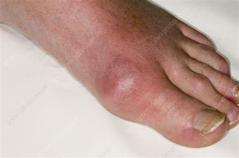 Gout of the big toe - Stock Image - C007/2724 - Science Photo Library