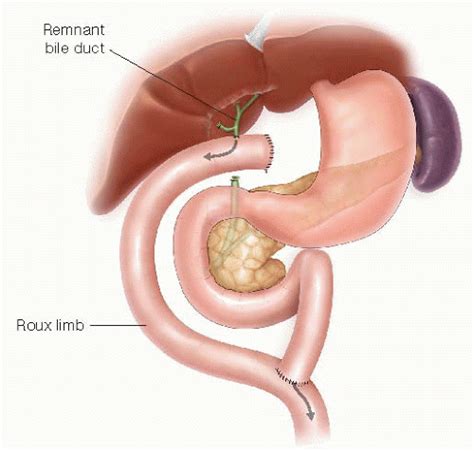 Roux En Y Hepaticojejunostomy