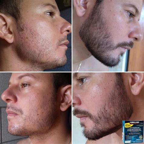 Minoxidil Before And After Beard