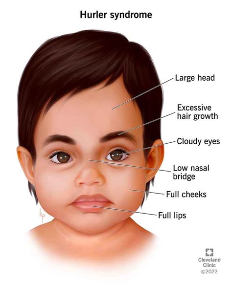 Mucopolysaccharidosis Type I: Hurler Syndrome - Symptoms & Causes