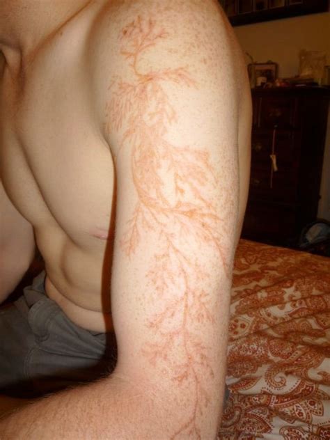 Lightning tattoos or Lichtenberg figures. --> Result of being struck by lightning. | Lightning ...