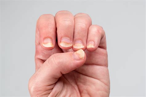 How Psoriatic Arthritis Affects Your Nails