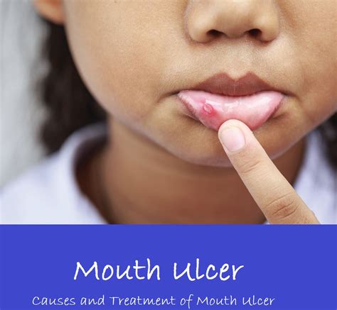 Mouth Ulcers – Causes and Treatment of Mouth Ulcer - HEALTH TIPS 101