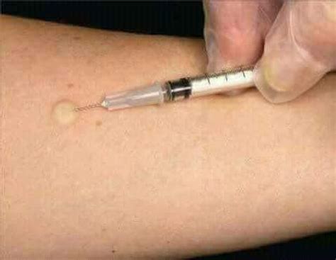 Tuberculin skin... - คลินิกเด็กหมอนงค์นุช เฉพาะทางโรคเด็กจากจุฬาลงกรณ์ ...