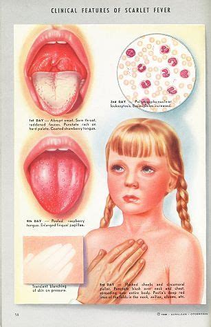 Scarlet fever: fever, strawberry tongue, sandpaper texture rash that ...