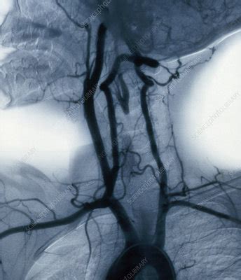 Angiogram of Carotid Arteries - Stock Image - C004/7408 - Science Photo Library