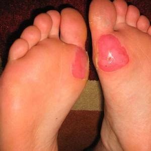 How To Treat Bad Blisters On Toes