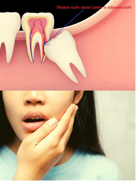 Wisdom tooth Infection Symptoms » www.medihelp365.com