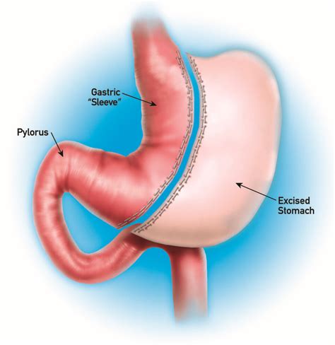 Sleeve Gastrectomy in Plano & Dallas, Laparoscopic Gastric Sleeve ...