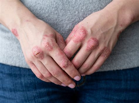 Is Inverse Psoriasis Natural Treatment Right For Me?