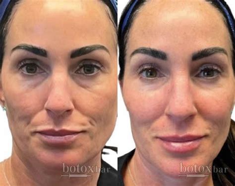 Cheek Filler Injection Plano, TX | Botox Bar