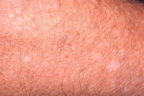 White Spots On Skin Causes Sun Legs Pictures Fungus V - vrogue.co