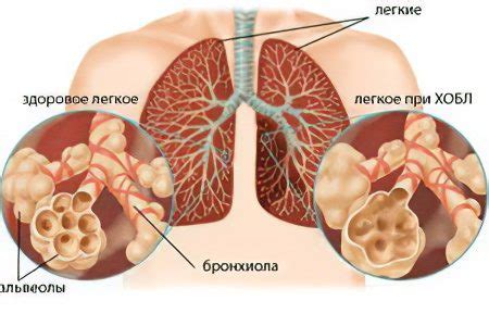 COPD: causes, symptoms, stages, treatment – Healthy Food Near Me