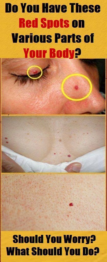 Tiny pinpoint red dots on skin causes by viruses - acugerty