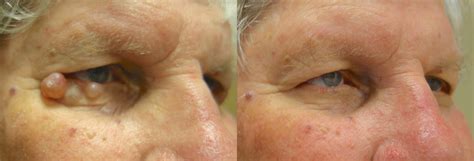 Eyelid Growth Removal Archives - In Focus Ophthalmic Plastic Surgery