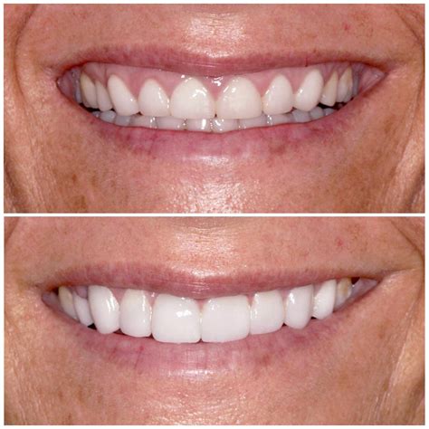 Gum Lifts Brisbane [Free Consult] | Smiling Dental