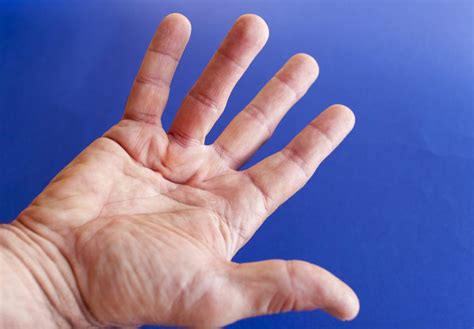 Can Dupuytren Contracture Be Painful? | Arora Hand Surgery