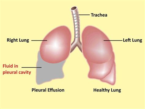 Parapneumonic Pleural Effusion