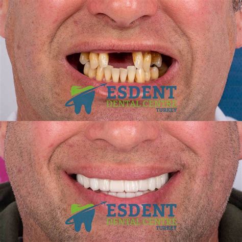 Same Day Dental Implants in Turkey - Esdent Dental Centre