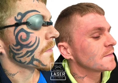 Laser Tattoo Removal - Whiteroom Laser Ltd