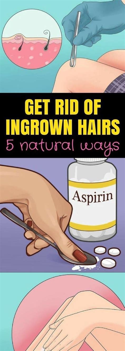 5 Natural Ways That Can Help You Get Rid Of Ingrown Hairs | Ingrown hair