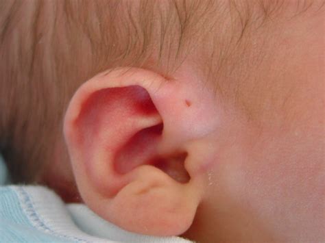 Starship - Ear anomalies in the newborn