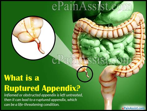 Ruptured Appendix|Causes|Symptoms|Treatment|Signs|Complications