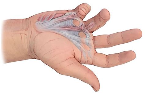 Dupuytren's contracture