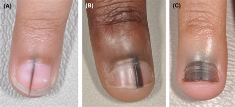 Nail discoloration in pediatric skin of color patients - Bellet - 2021 - Pediatric Dermatology ...